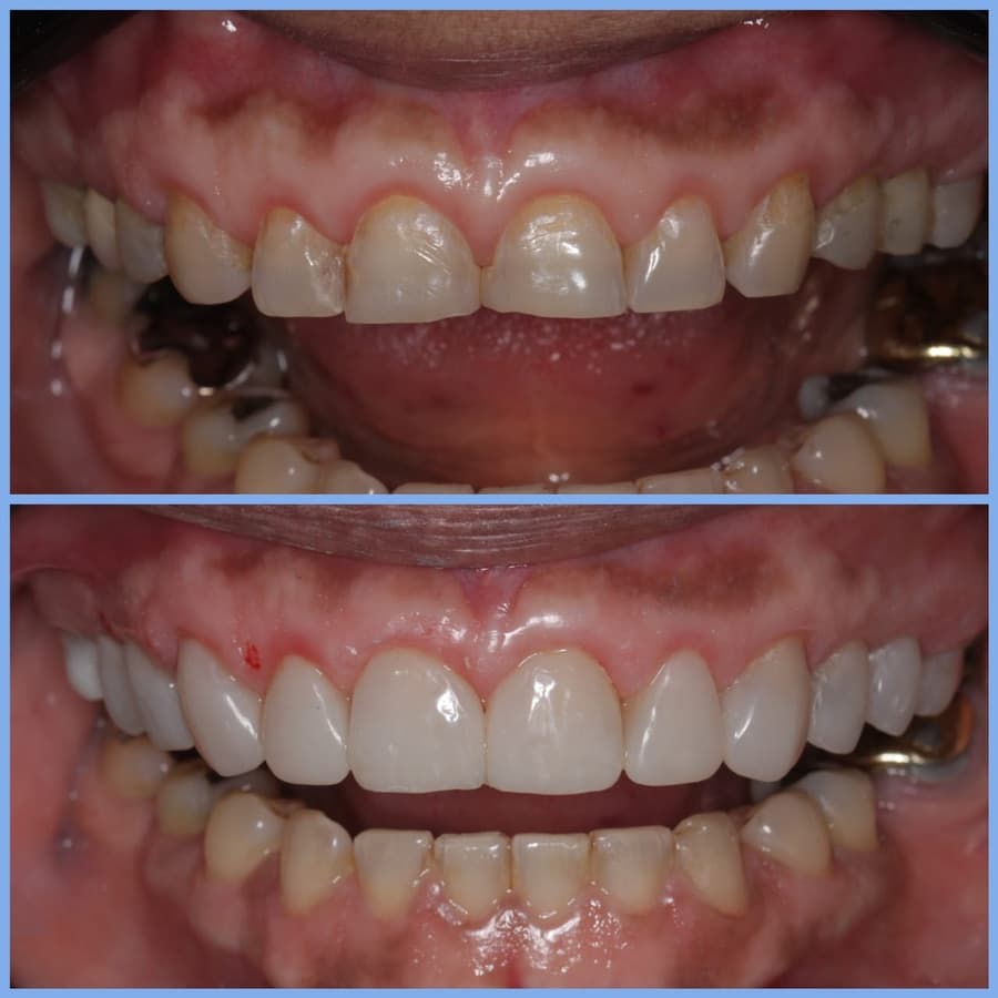 Antes e depois — Renata F.